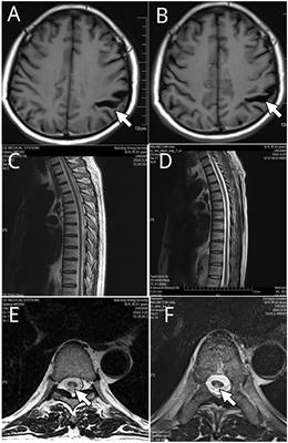 Case Report: Detection of Treponema phagedenis in cerebrospinal fluid of a neurosyphilis patient by metagenomic next-generation sequencing